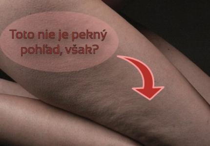 Celulitida-na-nohach